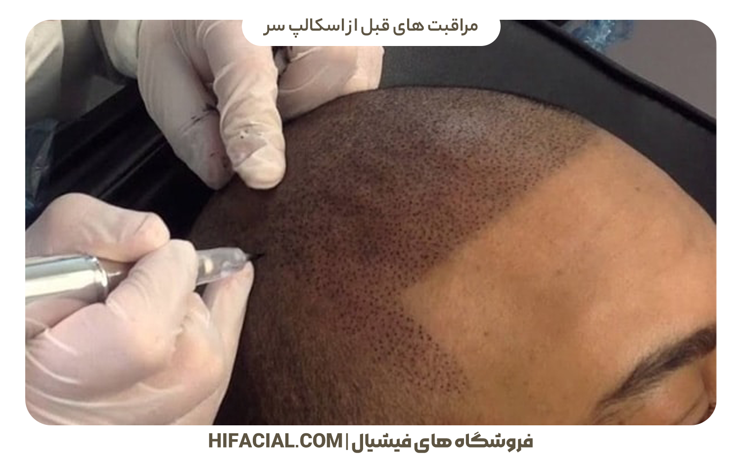 مراقبت های قبل از اسکالپ سر