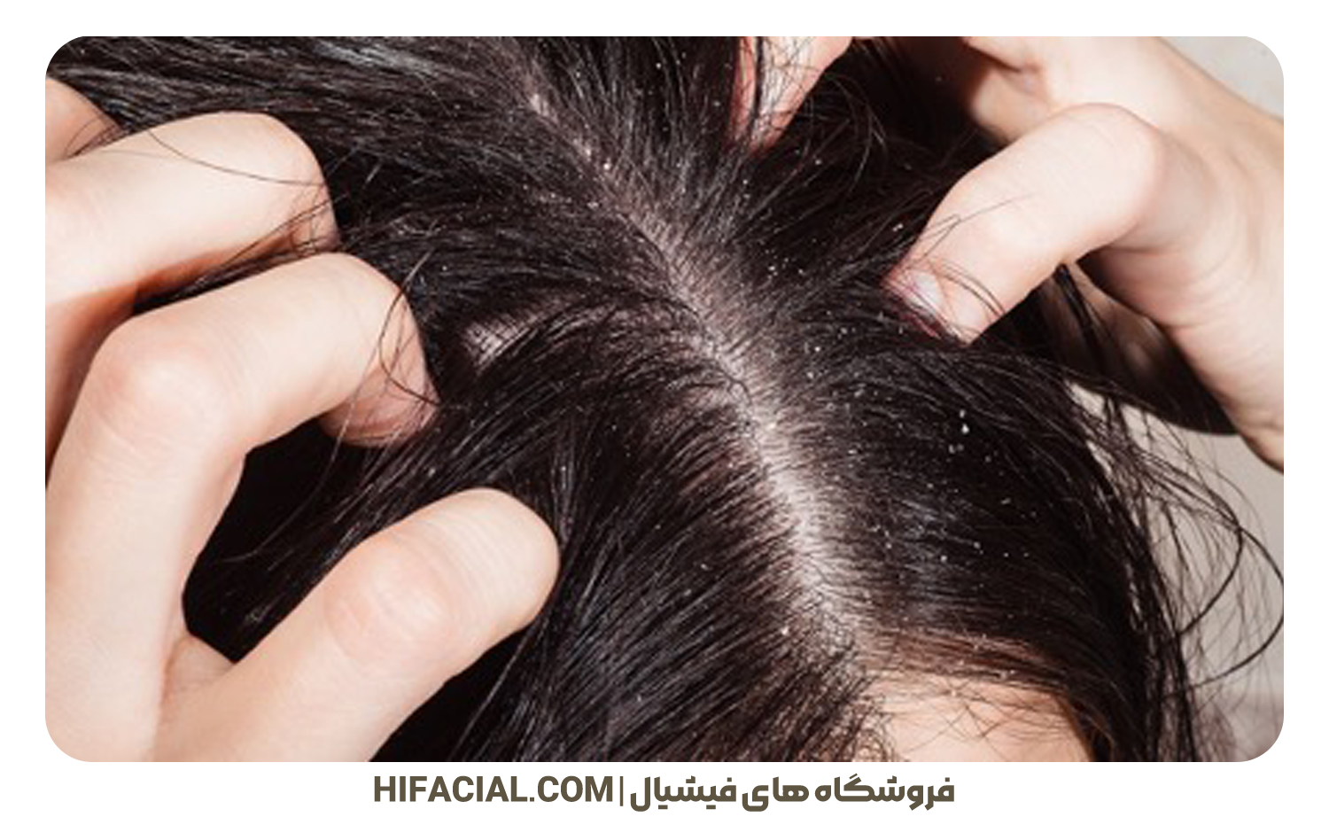 اسکالپ و شوره سر چیست؟
