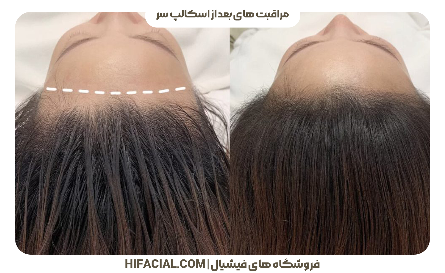 مراقبت های بعد از اسکالپ سر