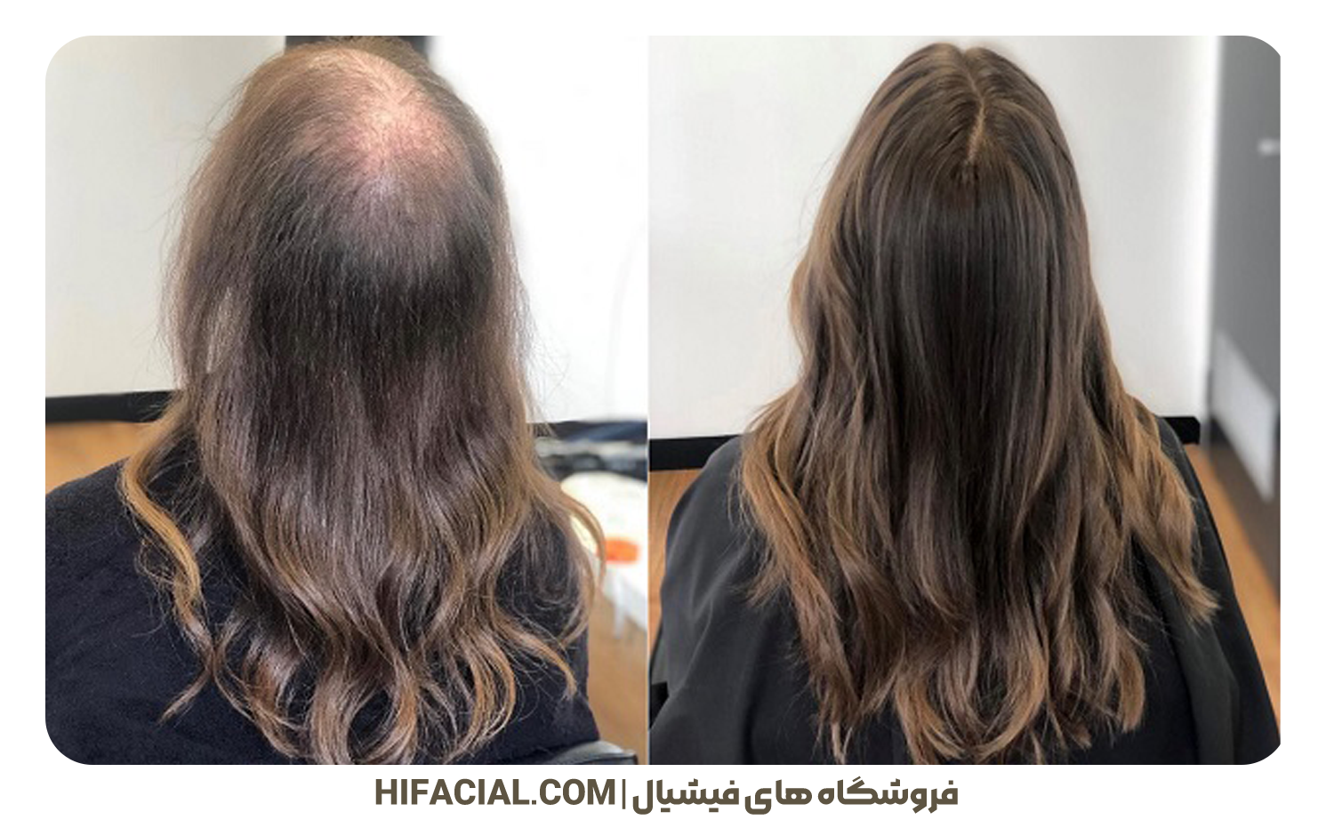 علت ریزش مو در زنان