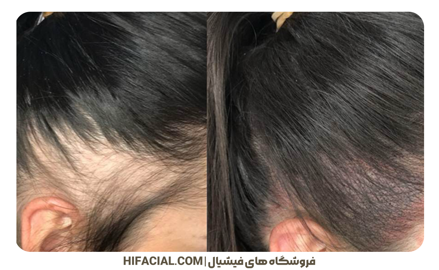 اسکالپ سر