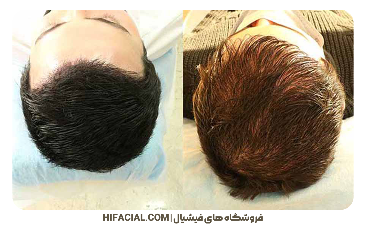 آموزش 0 تا 100 اسکالپ سر