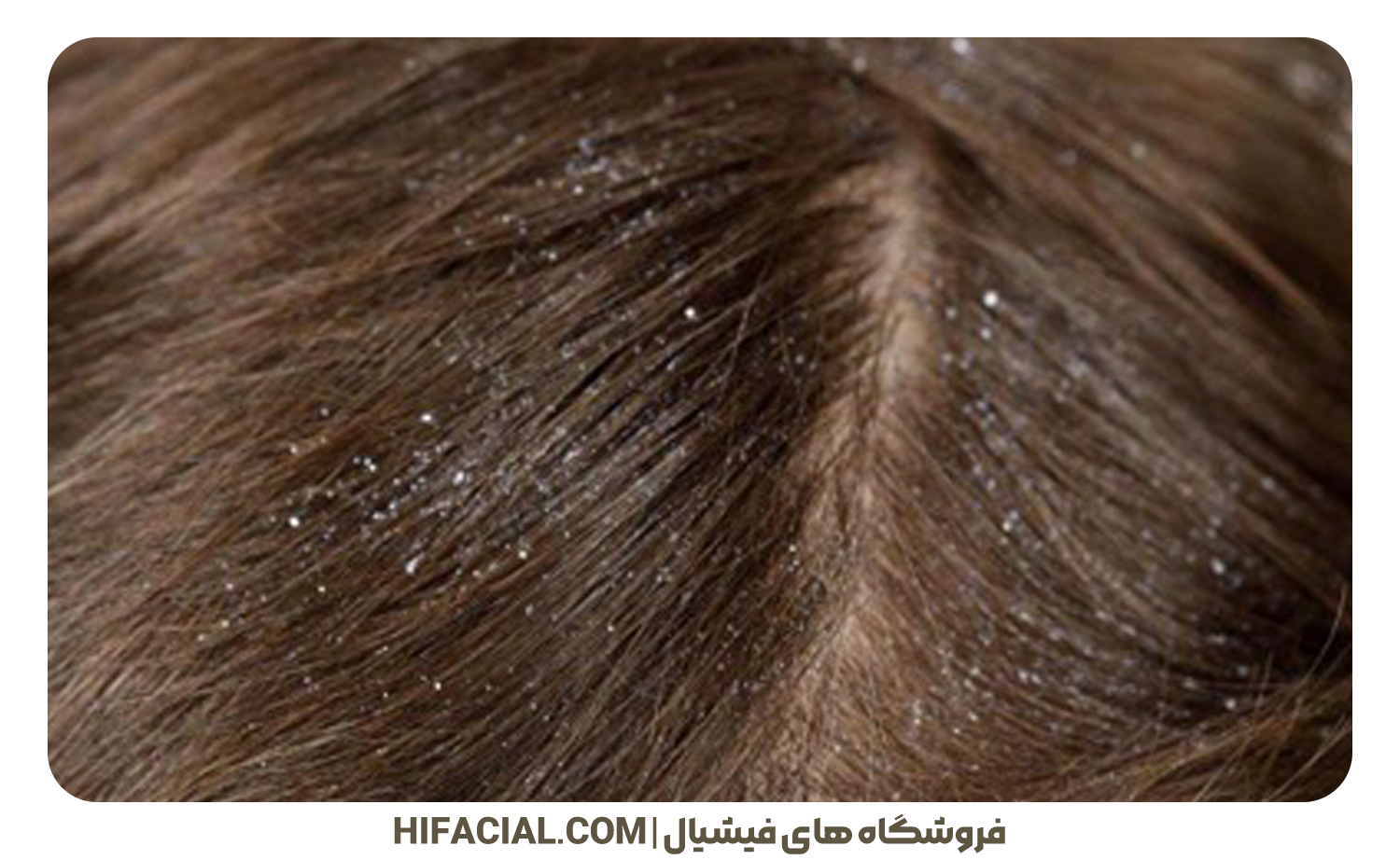 شوره سر