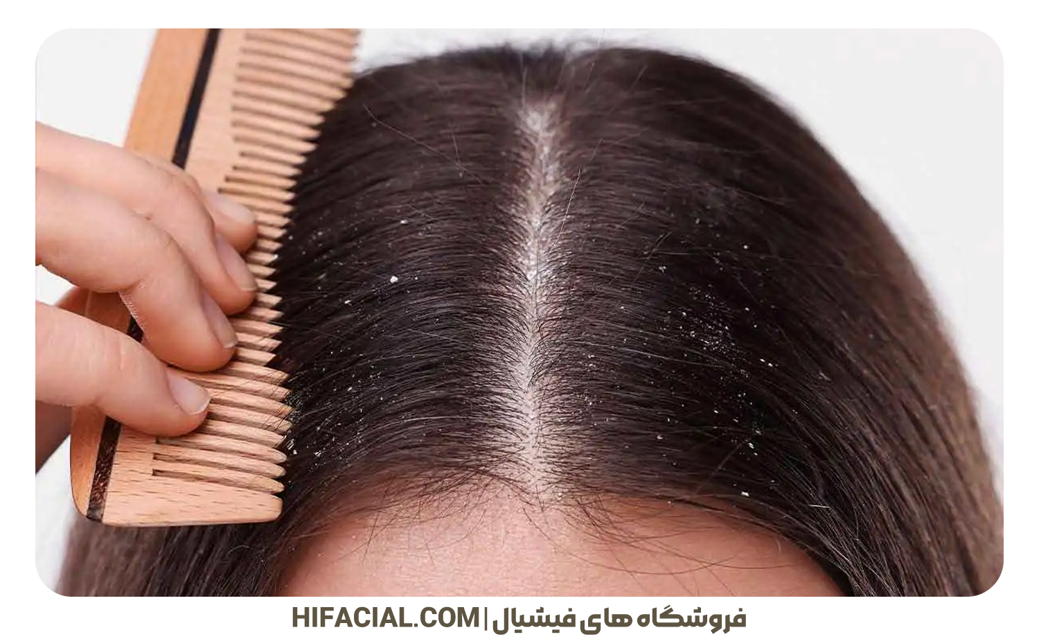 شوره پوست چرب