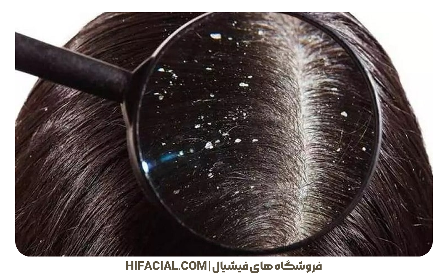 علائم شوره سر