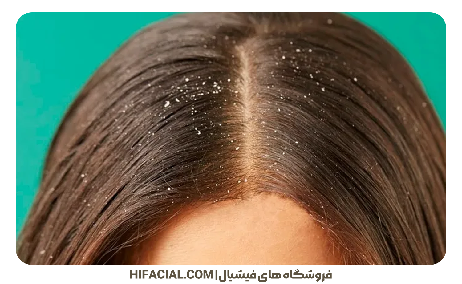 شوره سر چیست و چگونه به وجود میآید؟