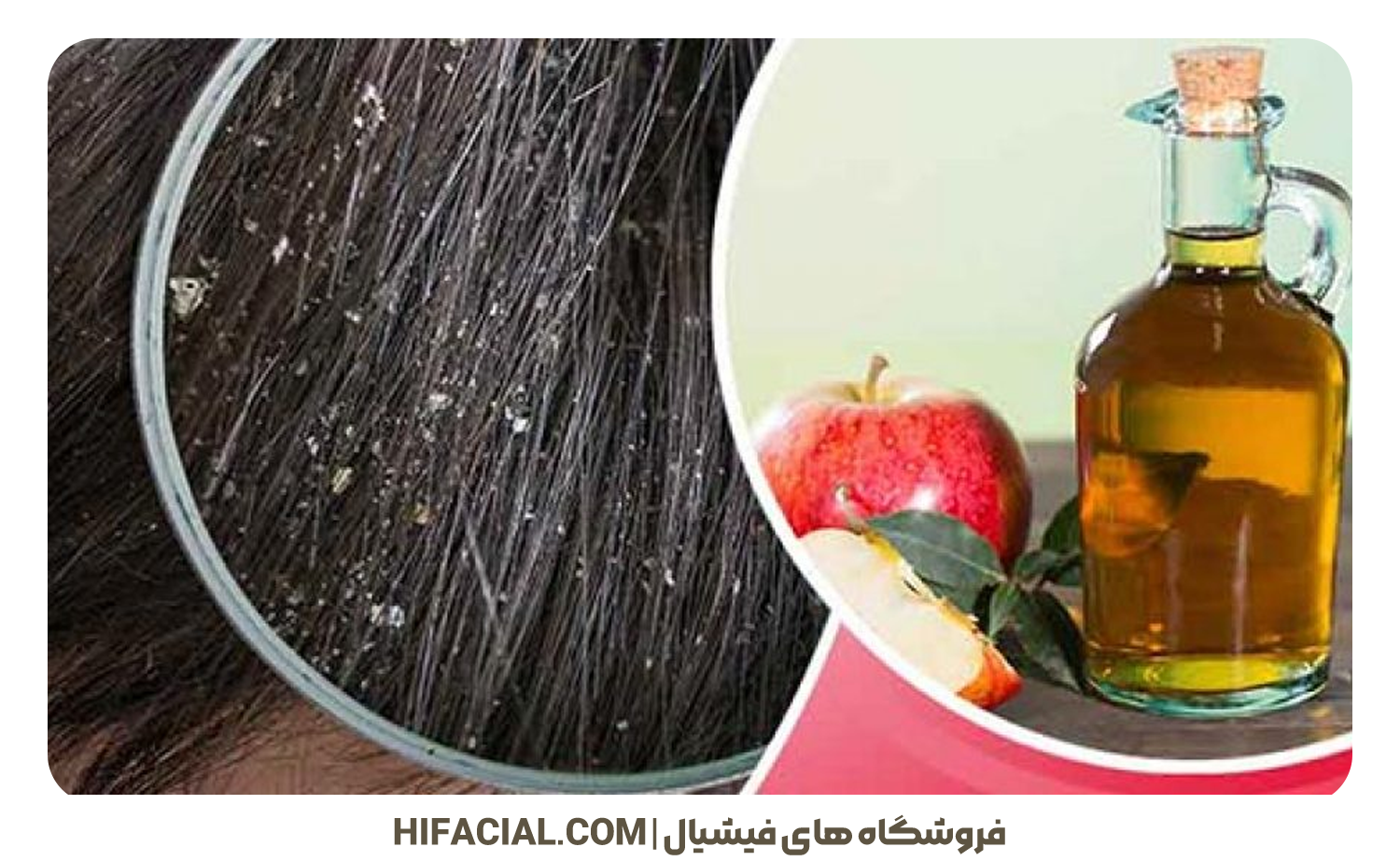 درمان شوره سر با سرکه سیب
